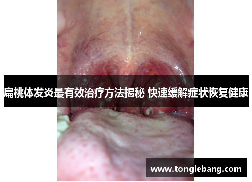 扁桃体发炎最有效治疗方法揭秘 快速缓解症状恢复健康