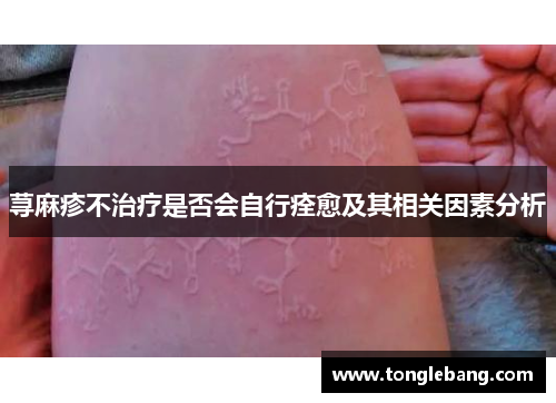 荨麻疹不治疗是否会自行痊愈及其相关因素分析
